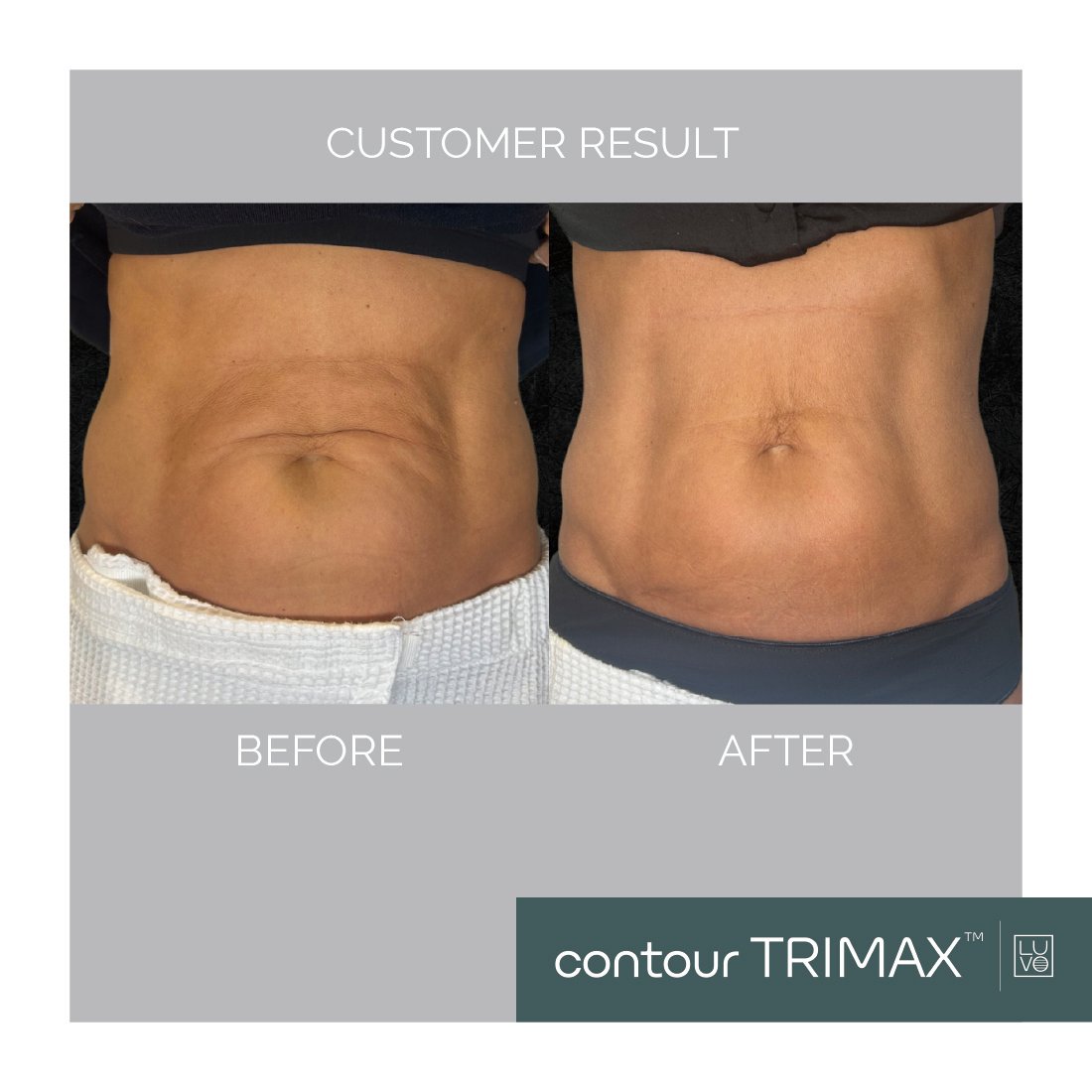 glp 1 sculpt touch reviews before and after Unlock New Revenue: Why Your Clinic Must Capitalize on the GLP-1 Body  Contouring Boom