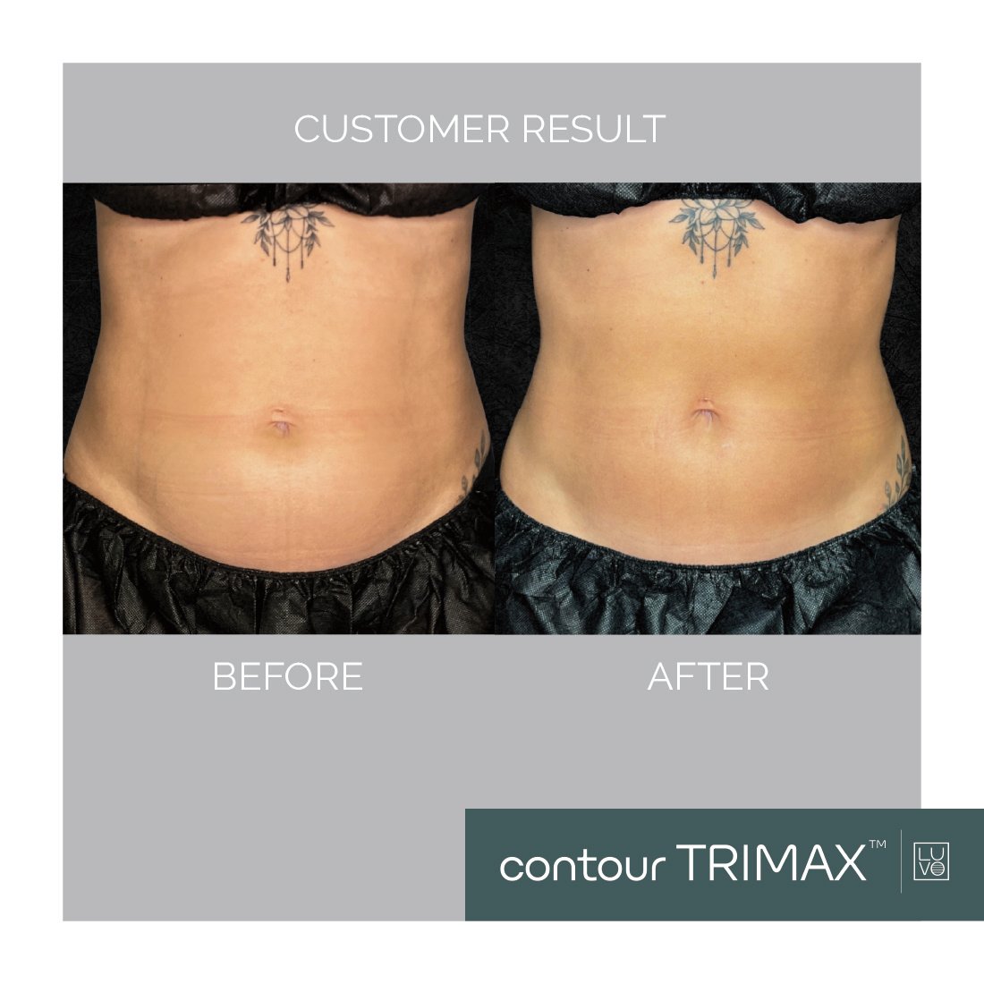 sculpt touch glp-1 reviews before and after Unlock New Revenue: Why Your Clinic Must Capitalize on the GLP-1 Body  Contouring Boom