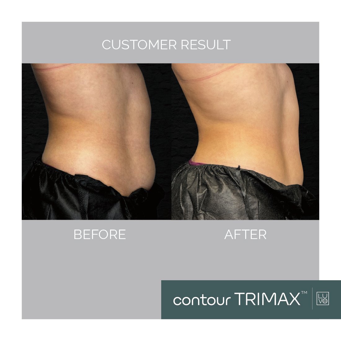 body contouring post glp-1 weight loss nyc Unlock New Revenue: Why Your Clinic Must Capitalize on the GLP-1 Body  Contouring Boom