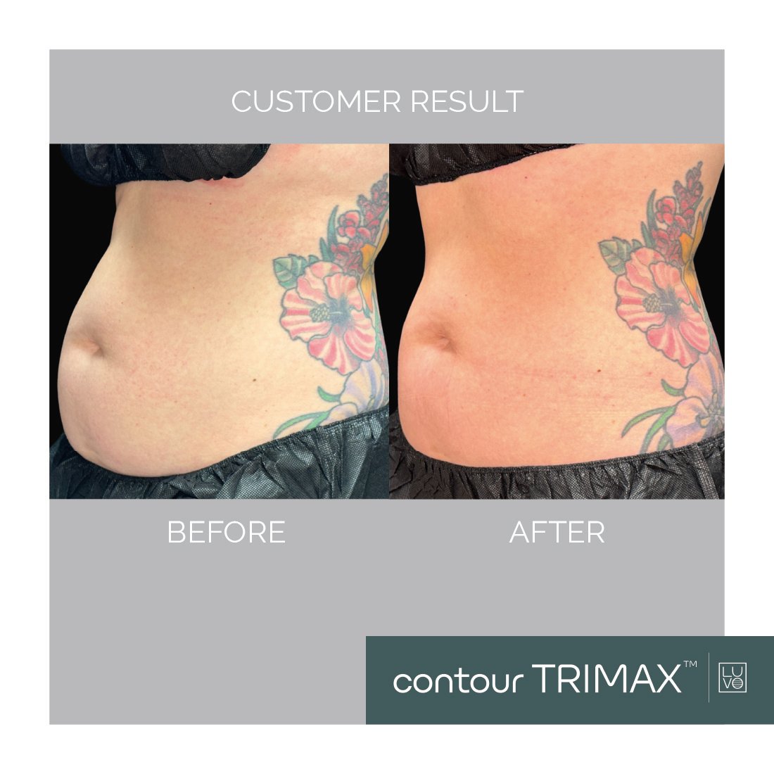 body contouring post glp-1 weight loss nyc Unlock New Revenue: Why Your Clinic Must Capitalize on the GLP-1 Body  Contouring Boom